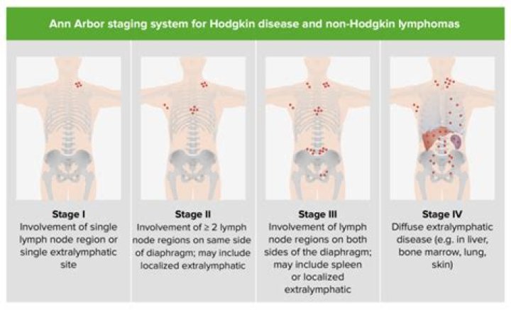 Can stress cause Hodgkin's lymphoma?