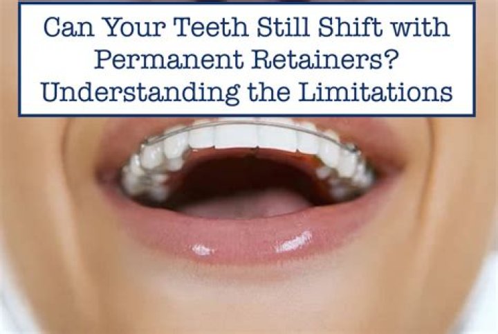 Can your teeth still shift with permanent retainers?