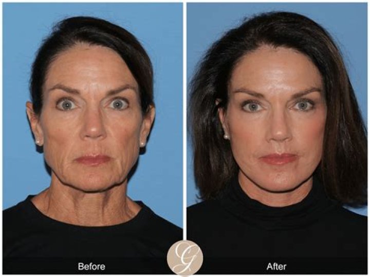 How can I make my facelift last longer?