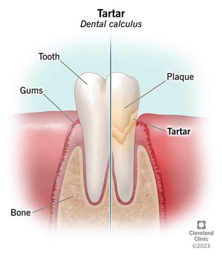 Is it tartar or my tooth?