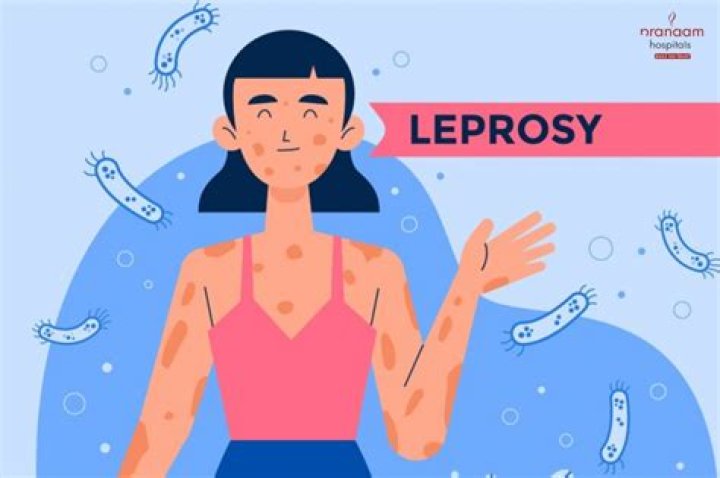 Why did leprosy decline in Europe?